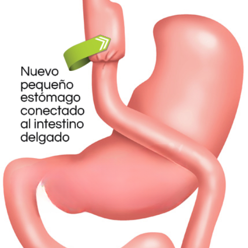 Bypass Gastrico